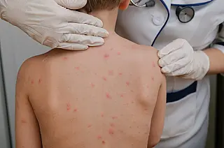 Cassilândia inicia campanha de vacinação contra o sarampo para crianças de 6 a 11 meses
