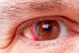 Dia Nacional de Combate ao Glaucoma