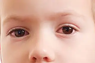 Adenovírus é a nova preocupação para as famílias: conjuntivite e sintomas fortes alertam pediatras
