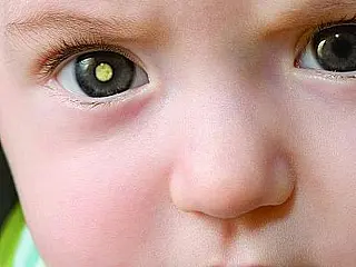Campanha de diagnóstico precoce do retinoblastoma é aprovada em 1ª sessão plenária