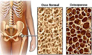 Dia Mundial da Osteoporose alerta para a importância da prevenção e do diagnóstico precoce