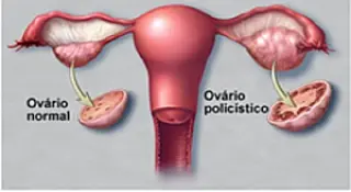 MS poderá ter semana de conscientização sobre a Síndrome do Ovário Policístico