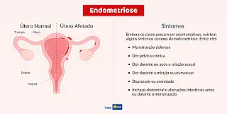 Dia Internacional da Luta contra a Endometriose alerta para diagnóstico precoce e tratamento da doen